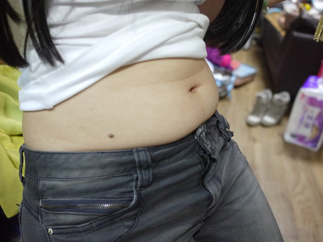 <瘦身>三週瘦大腿瘦4.5公分-完全埋線成果分享！打破埋線心悸迷思。