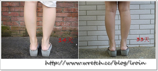 <醫美>小腿肉毒三月成果分享