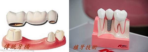 dental-bridge-horz